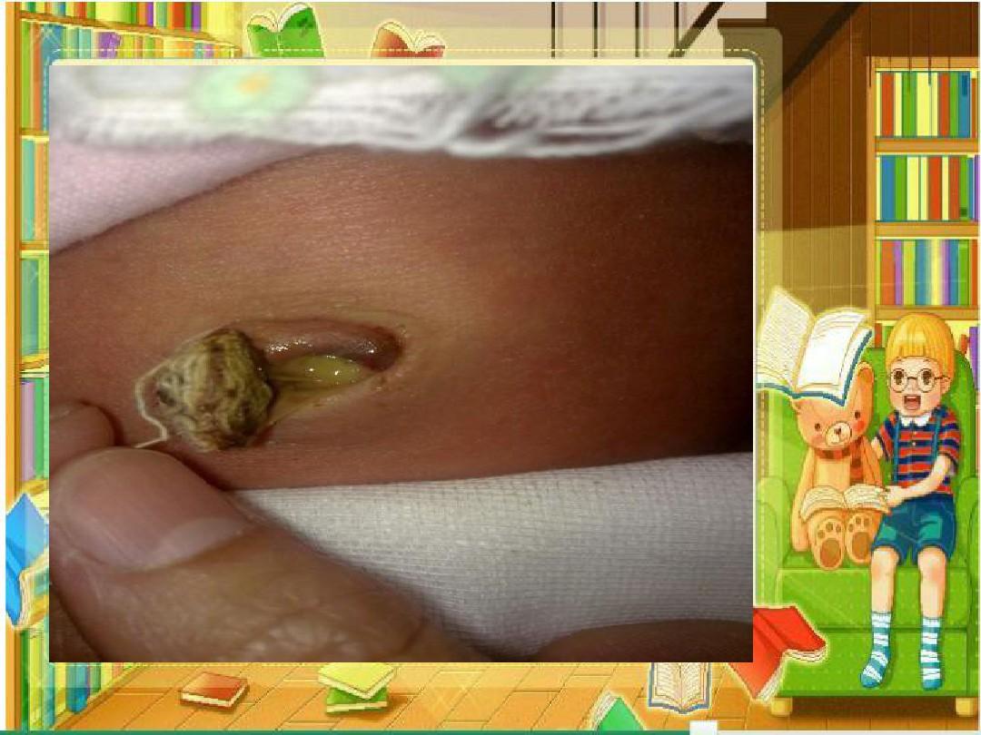 关于新生儿脐炎的科普小知识