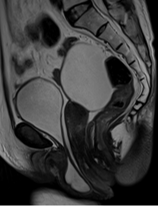 盆底磁共振的检查意义及注意事项